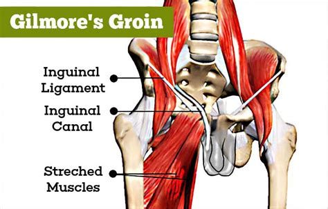 inguinal ligament pain